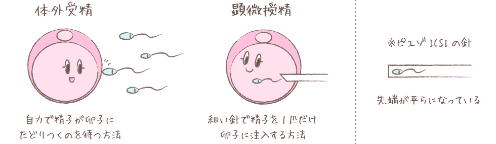 体外受精と顕微受精: ※※ピエゾICSIの針 先端が平らになっている