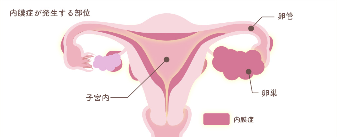 子宮外妊娠が発生する部分