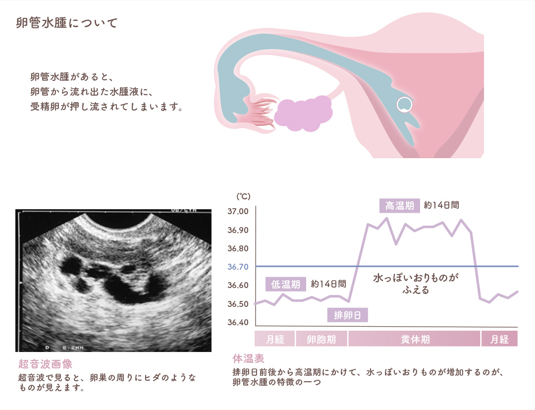 卵管水腫について