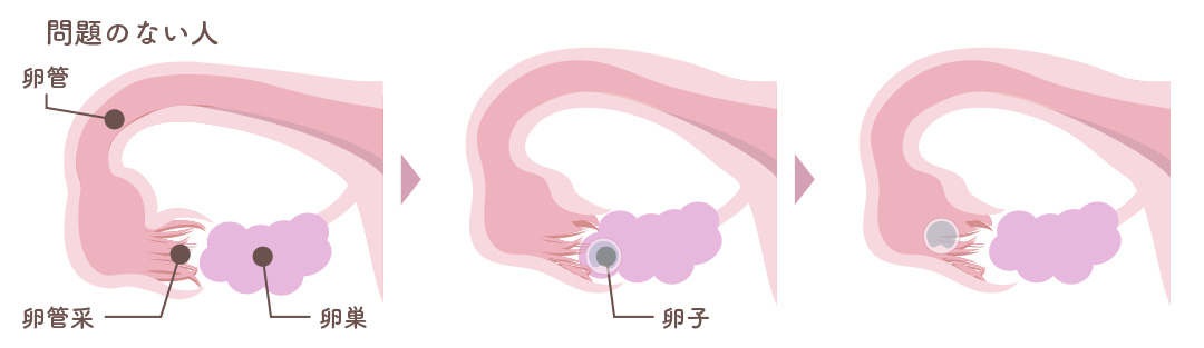 [卵管Pick up障害] 問題のない人