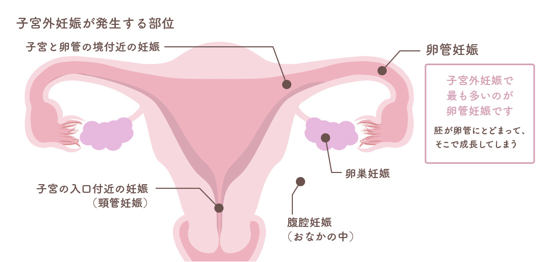 子宮外妊娠が発生する部位