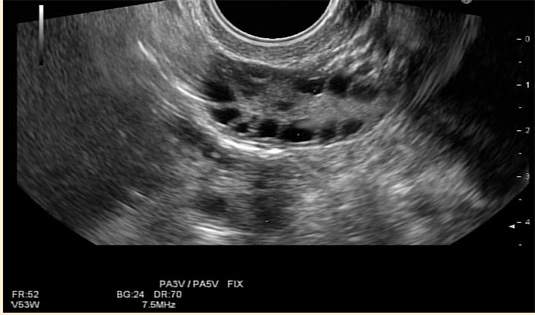 多のう胞性卵巣症候群(PCOS) エコー写真