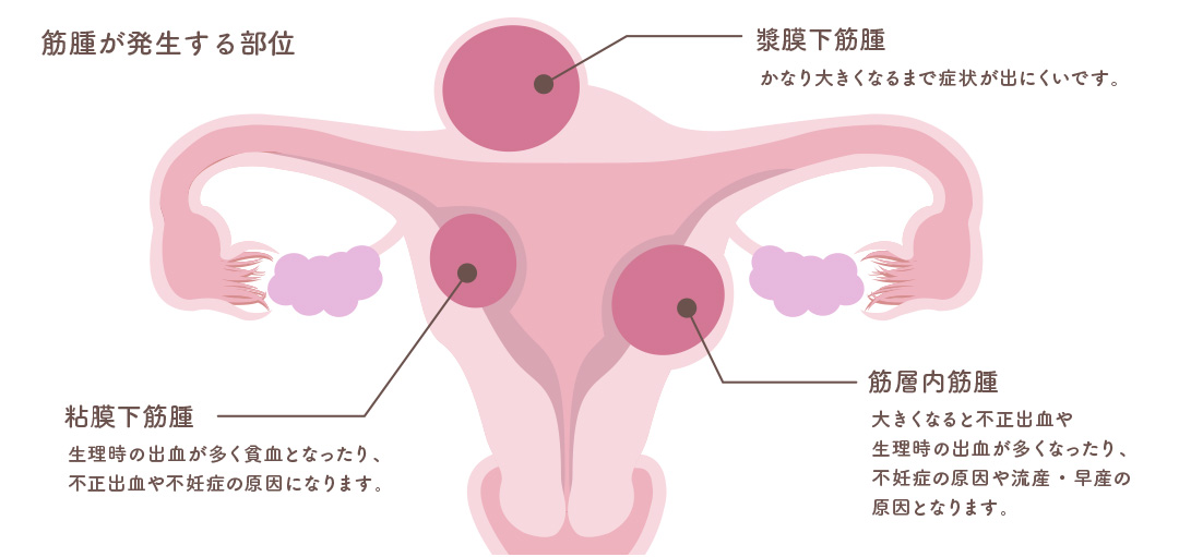 筋腫が発生する部位