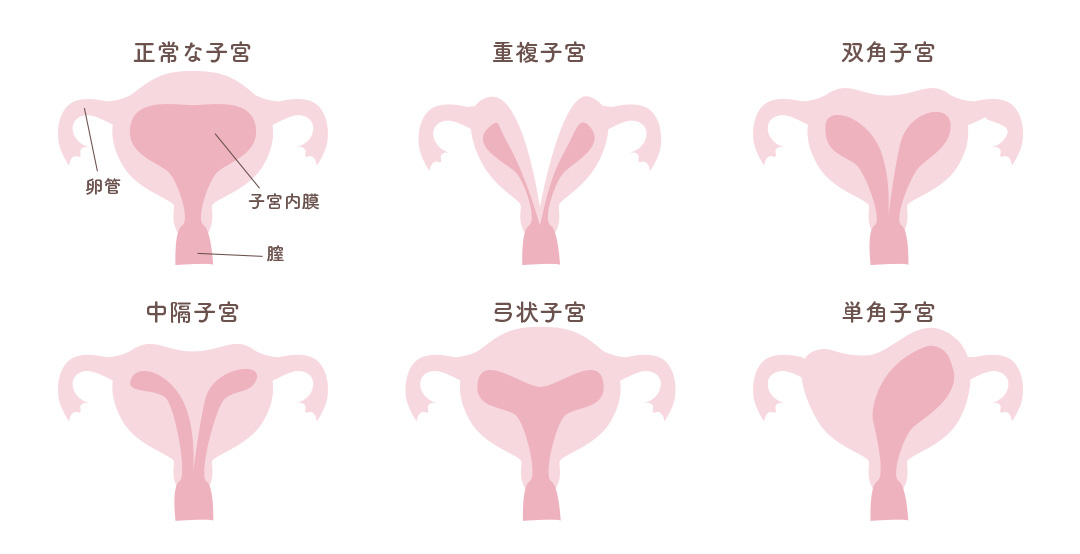 子宮奇形 一覧