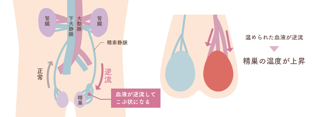 精索静脈瘤の仕組み