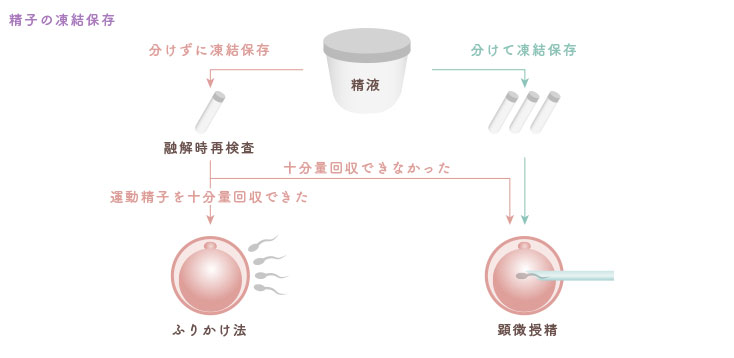 精子の凍結保存