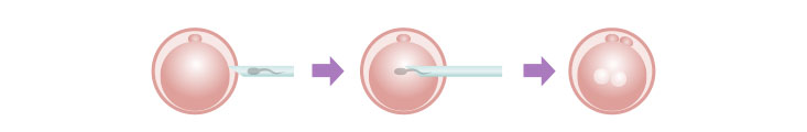 先端が鋭利な針を使用する方法(Conventional ICSI)