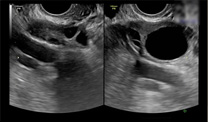 採卵周期d12超音波画像