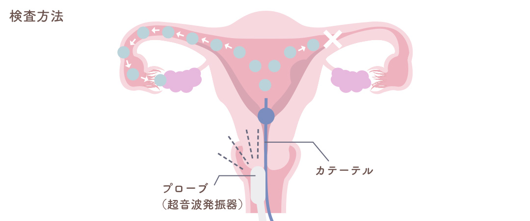 超音波下卵管通水検査 検査方法