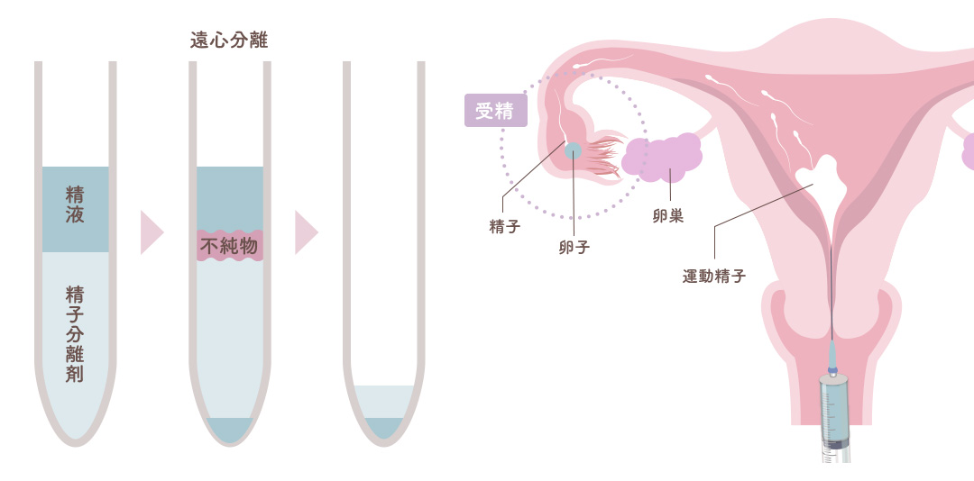 [人工授精] 遠心分離