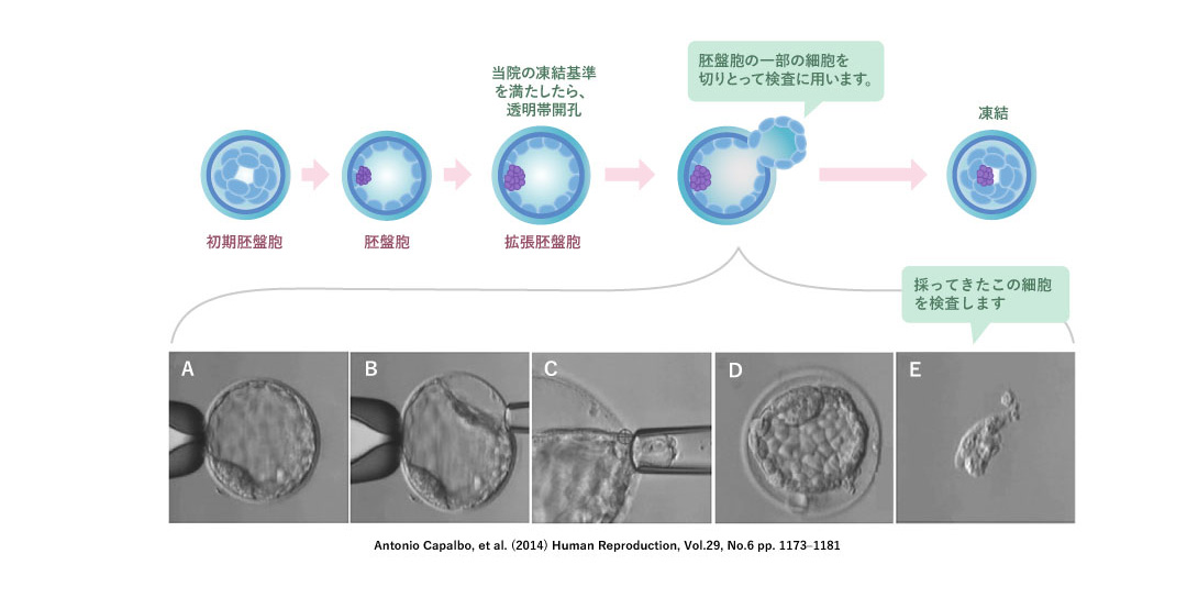 PGT-Aの方法