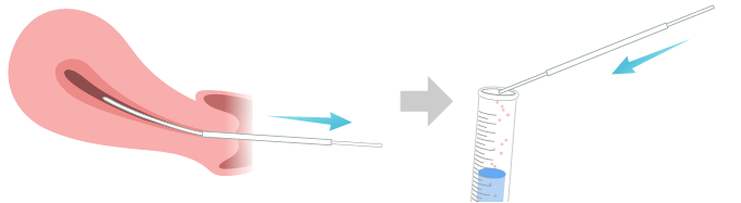 子宮内膜組織の採取